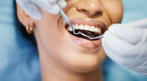 Best Emergency Wisdom Teeth Removal in Thornton, IL